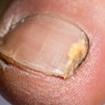 mycose des pieds